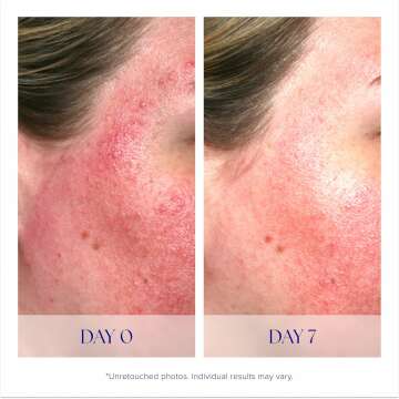 Pro-Heal Serum Advance+ for Redness and Inflammation