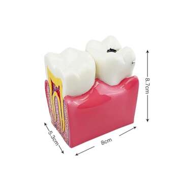 Dental Caries Tooth Model, YOUYA DENTAL Decay Teeth Comparative Study Model 6 Times Caries Tooth Teaching Tools