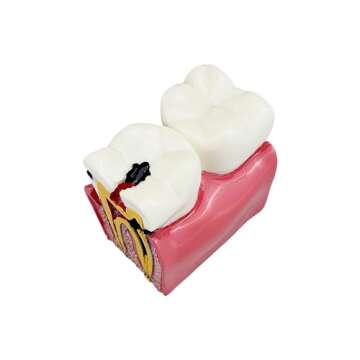 Dental Caries Tooth Model, YOUYA DENTAL Decay Teeth Comparative Study Model 6 Times Caries Tooth Teaching Tools