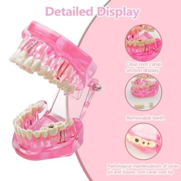 Windplusya Transparent Disease Teeth Model with Dental Implant Bridge, Dental Teach Crown Bridge Removable Model, Tooth Model for Patient and Dental Student Education. (Red)