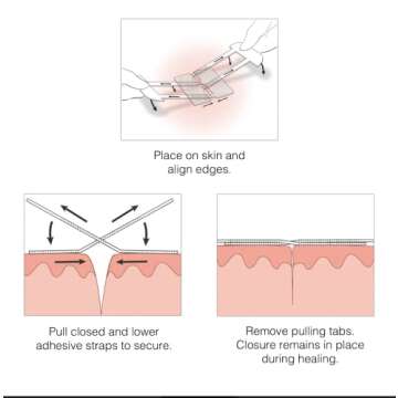 Clozex Skin Closure Device for Quick Wound Care