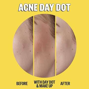 PEACE OUT Skincare Acne Day & Night Duo. 6-hour Fast Acting Sheer Hydrocolloid Pimple Patches and Overnight Acne Dots with Salicylic Acid, Stickers to Cover and Clear Breakouts, 20 dots