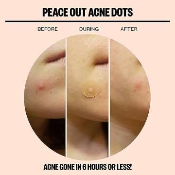 PEACE OUT Skincare Acne Dots, Hydrocolloid Pimple Patches Help Clear Blemishes Overnight, Award Winning Fast Acting Anti-Acne Solution, Jumbo Box (40 dots)